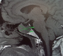 Endocrinologia - Tumor hipofisiario